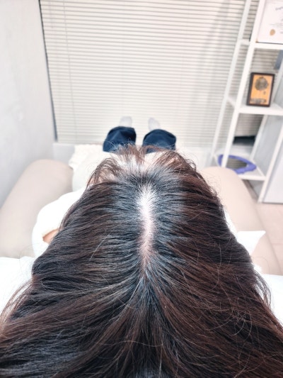 영등포 탈모 두피관리 추천 | 서울 미인점도 가능한 모다스튜디오 정수리 채움 시술 후기 이미지 15